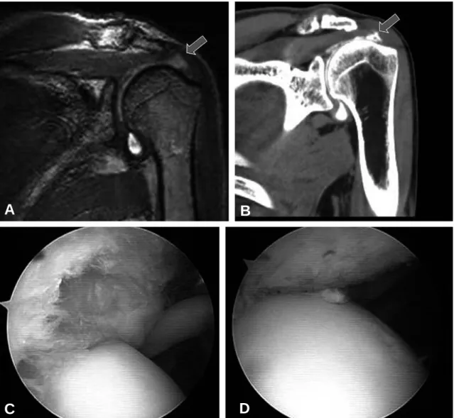 Fig. 3. PASTA lesion is well seen on both MR (A) and CT (B) arthrographic coronal images(arrow), confirmed at arthroscopy (C) Intraarticular view after complete repair of PASTA lesion (D).