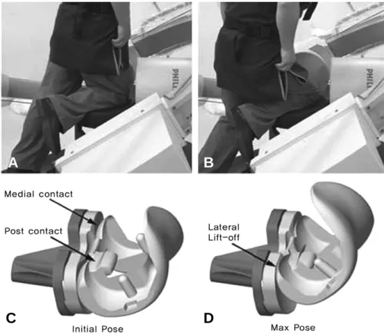Fig. 1. Patient performing the kneeling activity in the imaging system in which the initial (A)  and maximu (B) positions are shown