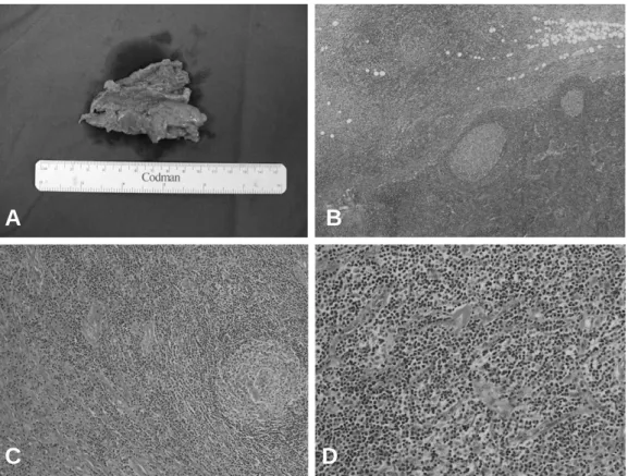 Fig. 3. (A) Gross findings of the specimen shows a gray-pinkish, fleshy, ill-defined lesion that blended into the surrounding subcutaneous fat