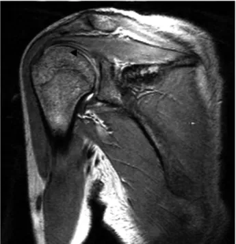 Fig. 3. Magnetic resonance image shows linear calcifications in the articular cartilage of the humeral head(arrowhead).