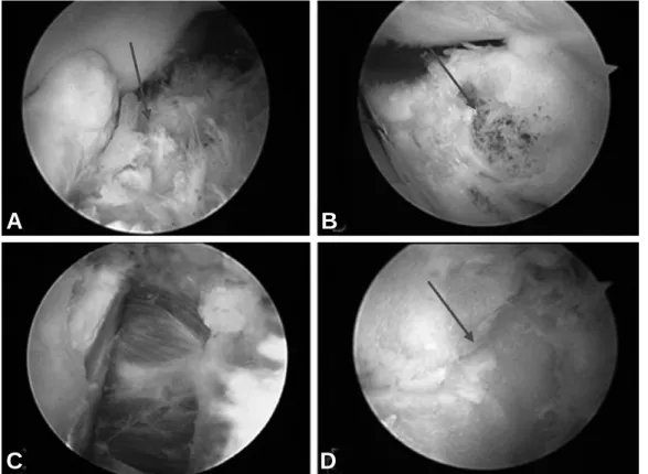 Fig. 2. Viewing from the medial portal (A) Arthroscopic finding shows narrowed articular space, osteo- osteo-phytes from the coronoid process