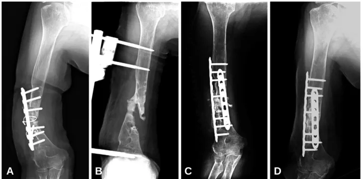 Fig. 1. 78-year-old woman with humerus shaft infected nonunion underwent the operation of open reduction and internal fixation using dual LCP fixation and autogeneous iliac bone graft