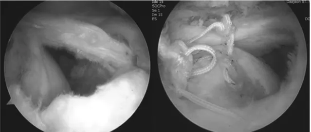 Fig. 1. Athroscopic finding showed large-sized rotator cuff tear and retear after arthroscopic repair.