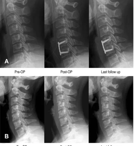 Fig. 1. Lateral radiographs of cervical spine after surgery, showing complete intervertebral fusion in last follow up x- x-ray