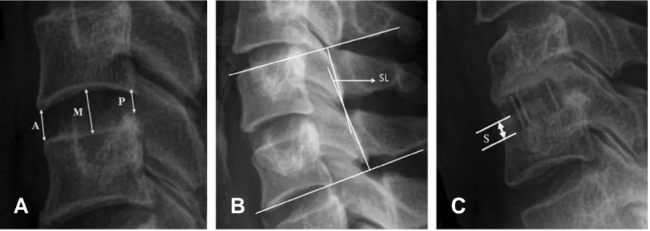 Fig. 2. Measurement of the radiographic outcome. Lateral radiograph of cervical spine demonstrating measurements of the (A) disc height (DH: DH=(A+M+P)/3), (B) segmental lordosis (SL), and (C) subsidence (S).