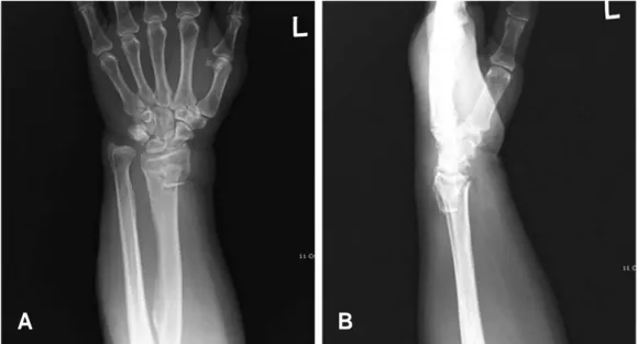 Fig. 1. Preoperative radiographs of 74-year-old female who had fallen down. Distal radius intraarticular fracture with dorsal com- com-minution and loss of radial shortening, radial inclination, volar tilting was seen