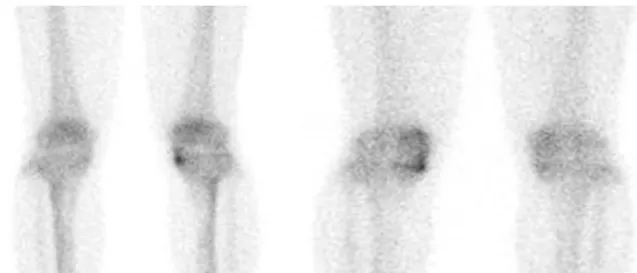 Fig. 1. 99m Tc MDP delayed image didn’t show a radionuclide uptake area involving the medial compartment of the right knee after arthroscopic partial menisectomy.
