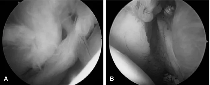 Fig. 2. This arthroscopic picture showed Type II SLAP lesion of a right shoulder (A), which was repaired by using anchor and non- non-absorbable suture (B).