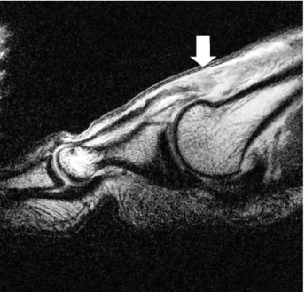 Fig. 1. Sagittal image of MRI revealed the rupture of the EHL tendon at the level of the first metatarsal head (arrow).