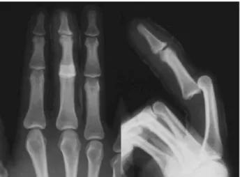 Fig. 1. Radiographs after third dislocation. On lateral view, volar dislocation of proximal interphalangeal (PIP) joint was seen
