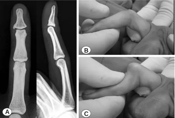 Fig. 3. Photographs at operation. (A) The central tendon was identified as being distension