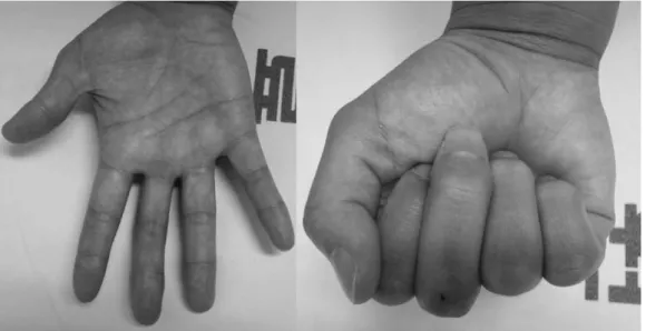 Fig. 4. Photographs at 9 month after operation. Active range of movement was recorded at 10�to 90�and 0�to 30�at the PIP and distal interphalangeal joints, respectively.