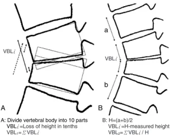 Fig. 1. The diagram shows the method used to assess the preop- preop-erative initial vertebral body loss (VBL(x))