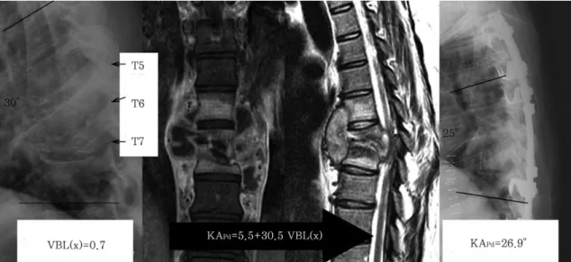 Fig. 5. A 26-year-old female patient with T 5-7 Tbc spondylitis, with a VBL(x) of 0.7: the KA Pre was 30 �before surgery and final postoperative KA (KA Final ) was 25 �