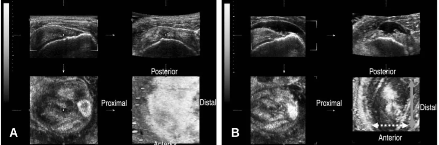 Fig. 2. Arthorscopic measurement was done by spinal needle and Kirschner wire.