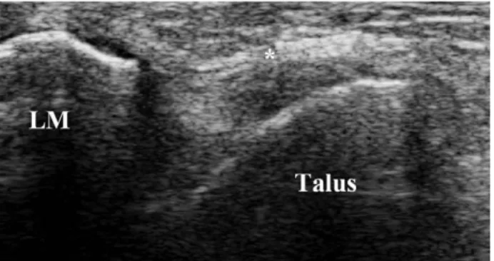 Fig. 1. Long-axis US image over the anterior talofibular ligament (*) of the patient shows complete rupture of the ligament from the lateral malleolus (LM).