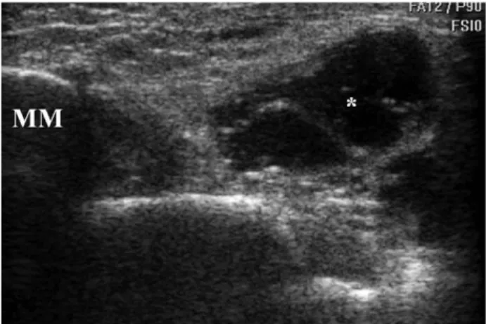 Fig. 8. Long-axis US image shows large anechoic cys- cys-tic lesion (*) within the tarsal tunnel