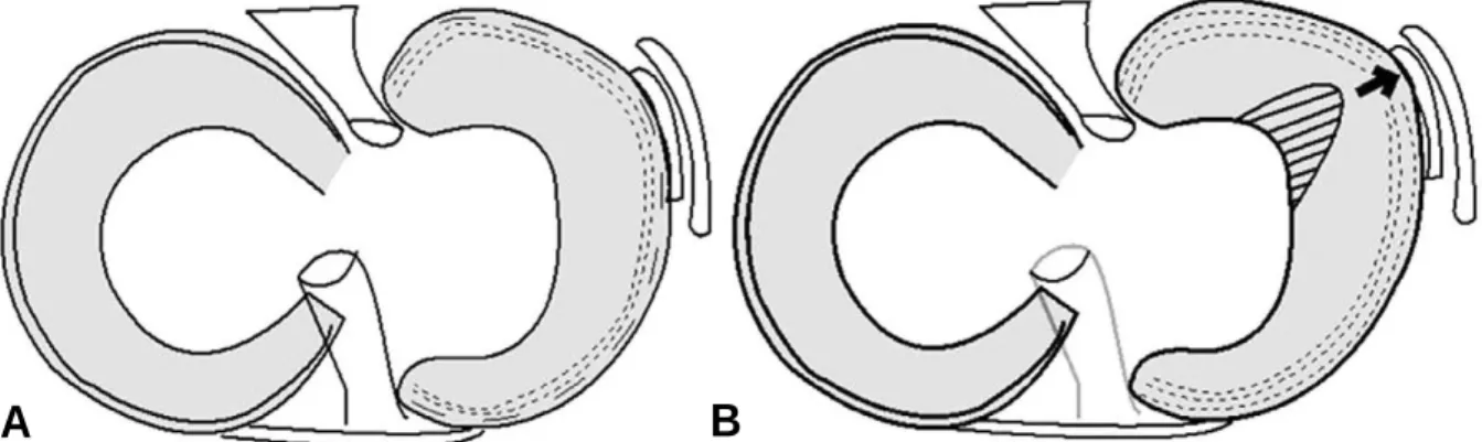 Fig. 2. (A) A scheme of the intact circumferential fiber of the medial meniscus. (B) The extruded medial meniscus due to the alteration of the hoop strain causing the circumferential fiber disruption.
