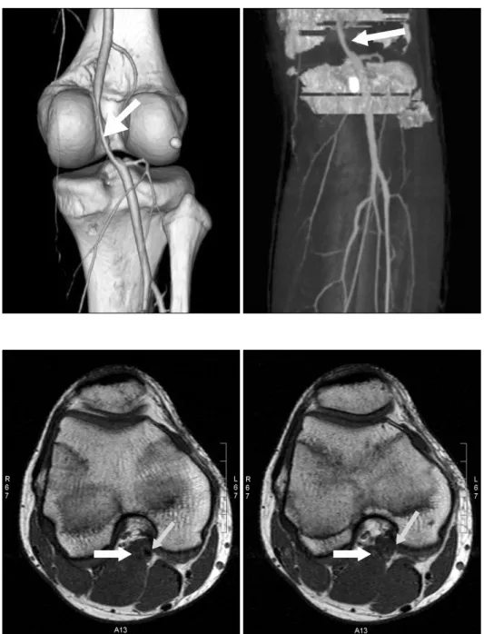 Fig.  1. CT angiography shows  focal,  well-defined,  severe  stenosis  of  Rt.  popliteal   ar-teries (arrows).