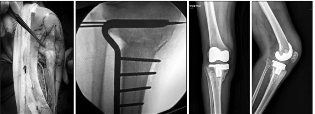 Fig.  4.  Preventing the tibial  component  to  abut  on  the  lateral cortical bone of tibia,  the complete medial  cortico-tomy  and  lateral  translation  was  performed  during  high  tibial osteotomy