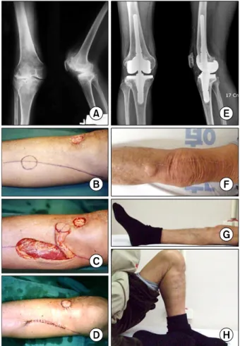 Fig.  3.  (A)  69-years-old  man  with  osteoarthritis  and  diabetes. (B) Infrapatellar ulcers developed after TKA with  NexGen Ⓡ  LCCK (Legacy Ⓡ  knee constrained condylar knee),  and 3×4 cm tissue defect exposing underlying patellar  ten-don  was  seen 