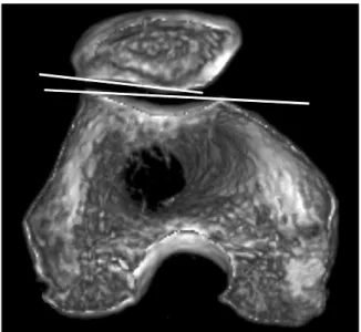 Fig.  2. Congruence angle between halving sulcus angle and  line between sulcus and inferior dome of patella  (dotted  line).