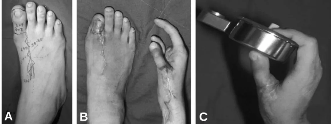 Fig. 3. (A) Preoperative marking of wrap around flap. (B) Post-operative 3 months view (donor and recipient site)