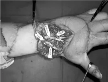 Fig. 7. Intra-operative view of tendon reconstruction (extensor carpi radialis, abductor pollicis longus, extensor pollicis longus, extensor pollicis brevis).