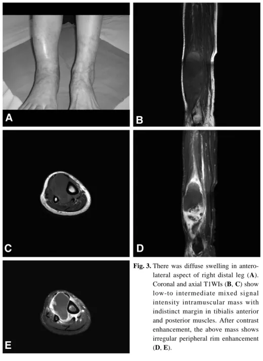 Fig. 3. There was diffuse swelling in antero- antero-lateral aspect of right distal leg (A).