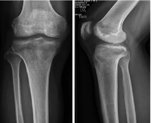 Fig. 1. Initial plain radiograph of right proximal tibia shows osteolytic lesion with cortical disruption in medial epi- epi-metaphysis.