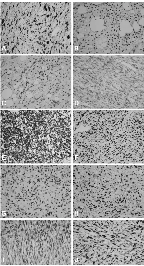 Fig. 1. This figure shows immunostaining in various soft tissue sarcomas. Cyclin D1 (A), cyclin E (B), CDK4 (C), CDK2 (D), p16 (E), p27 (F), Rb (G), p53 (H), E2F1 (I) and Ki-67 (J).
