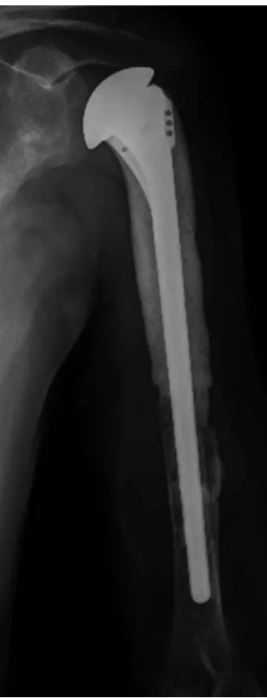 Fig. 4. En bloc excision of proximal humerus including the pasteurized bone and reconstruction with shoulder hemiarthroplasty was performed
