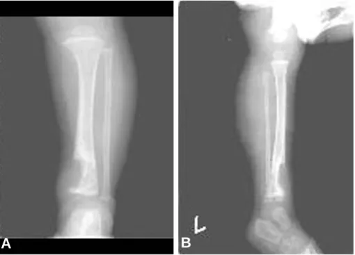 Fig. 2. Well enhancing mass in distal metaphysis and diaphysis of left tibia is shown in the coronal  T1-weighted (2A) &amp; T2-weighted (2B) MR image.