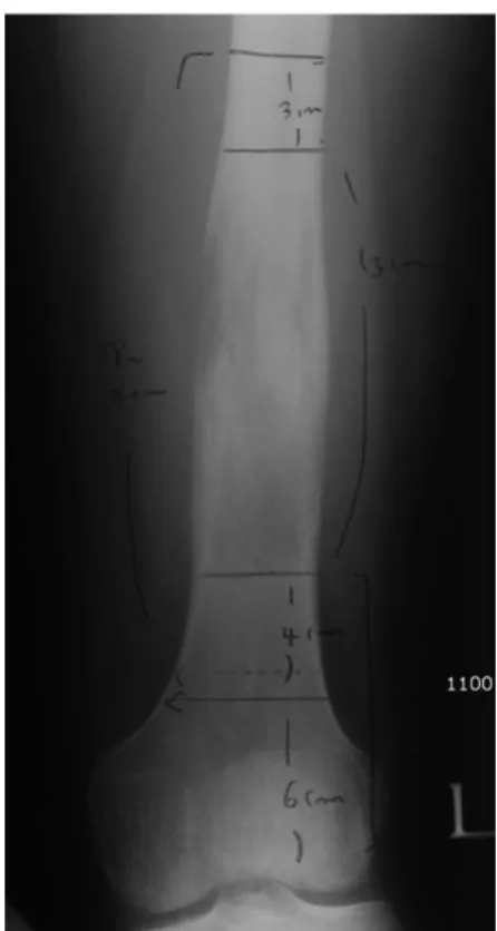 Fig. 3. On postchemotherapeutic MRI, margination of intramedullary tumor and shrinkage of  extracorti-cal mass is identified.