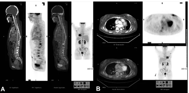 Fig. 1. A 41-year-old female with breast cancer. (A) The sagittal PET-CT image shows a focus of FDG hypermetabo- hypermetabo-lism in first lumbar vertebra body, suggesting bony metastasis