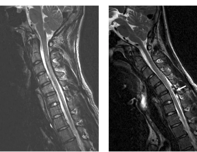 Fig. 4. Enhanced T2 weighted sagittal image of the cervical spine in the neck flexion position demonstrates an  ante-rior shifting of the posteante-rior wall of the cervical dural sac and vascular signal flow void (white arrow) inside the enhancement of th