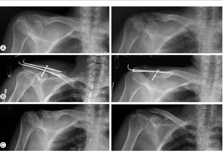 Fig. 3. (A) Initial plain X-ray pictures show fracture line at right distal clavicle, (B) The postoperative radiograph shows a satisfacto- satisfacto-ry reduction after internal fixation with K-wires and screw, (C) The postoperative 4 month radiograph show