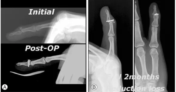 Fig. 2. Bony mallet fracture on 5th finger was operated. (A) Preoperative and postoperative radiographs, showing anatomic reduction of the fracture