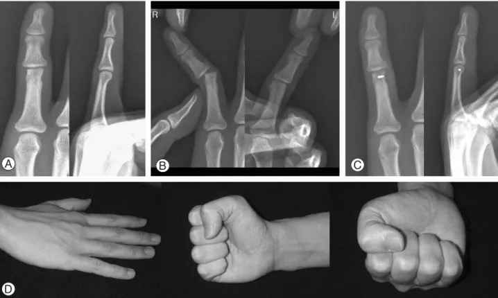 Fig. 2. Case 4. (A) Initial radiographs showed subtle bony loss at the radial side of fifth proximal phalangeal head