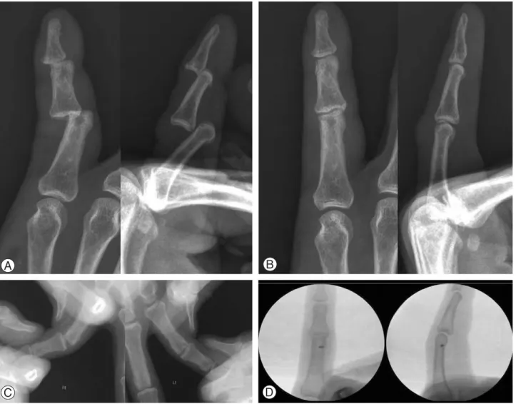 Fig. 3. Case 8. (A) Initial radiographs showed simultaneous dorsal dislocation of both interphalangeal joints of the little finger
