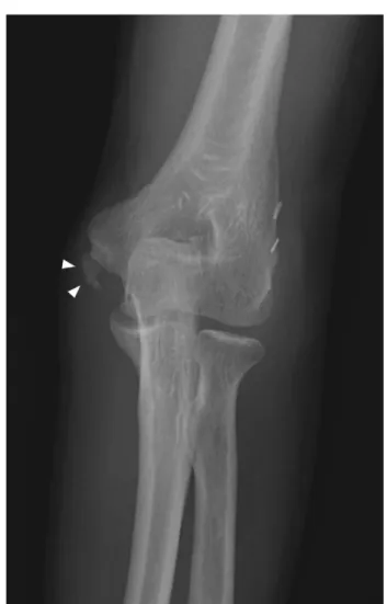 Fig. 1. Initial photograph shows open dislocation of the elbow and multiple muscles rupture.