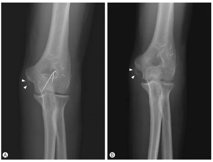 Fig. 4. (A) Anteroposterior radiograph obtained at 15 weeks reveals consolidation of the ectopic bone with poorly defined borders.