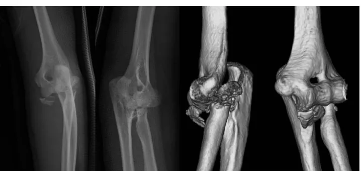 Fig. 2. The patient shows nearly full range of the left elbow motion at 19 months after the operation.