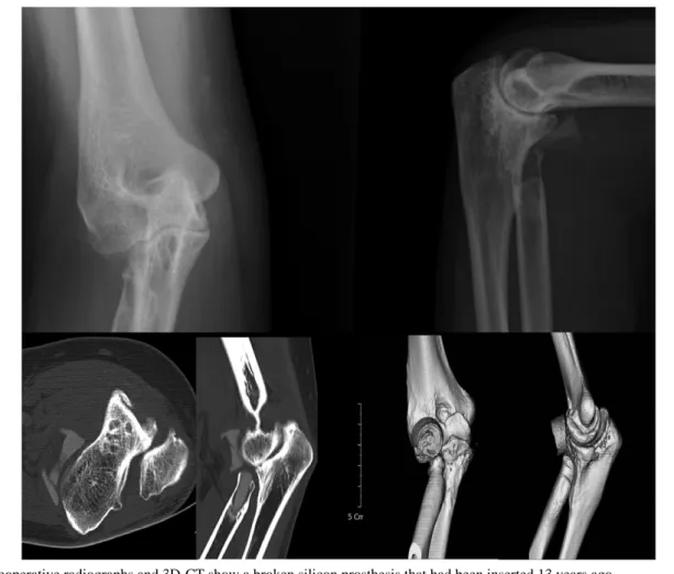 Fig. 3. Preoperative radiographs and 3D-CT show a broken silicon prosthesis that had been inserted 13 years ago