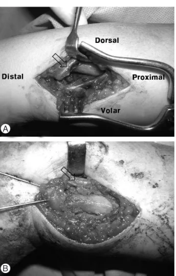 Fig. 2. (A) Intraoperative photographs show interposition of extensor carpi ulnaris tendon (arrow) between the  frag-ments