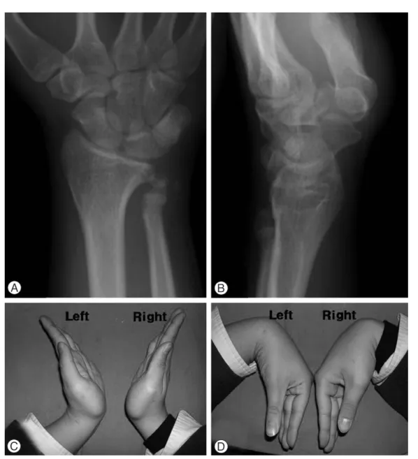Fig. 4. Radiographs three years after the operation. (A) Posteroanterior radiograph. (B) Lateral radiograph