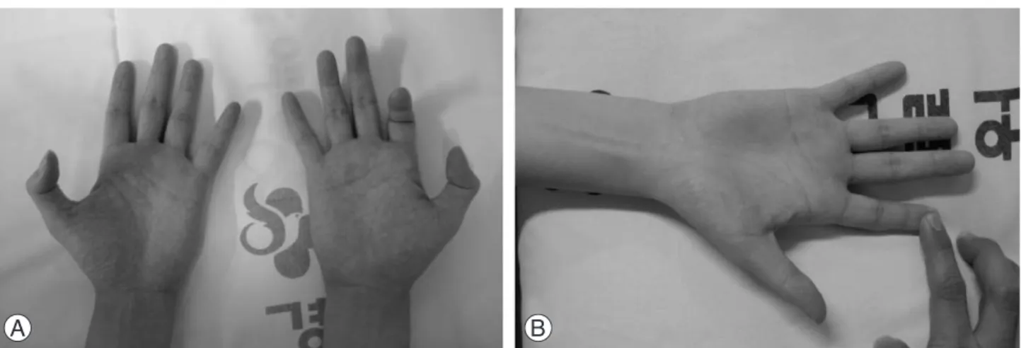 Fig. 1. (A, B) Clinical evidence of an anomalous connection between FPL tendon and the index FDP tendon includes the inability to perform active flexion of the thumb interphalangeal joint without also allowing the distal interphalangeal joint of either the