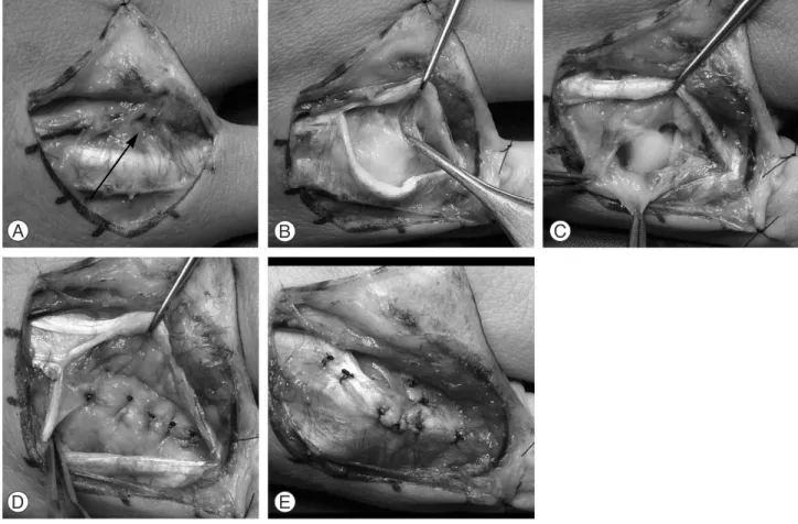 Fig. 1. (A) The affected site (arrow) surrounded by inflammatory change on the radial sagittal band can be found