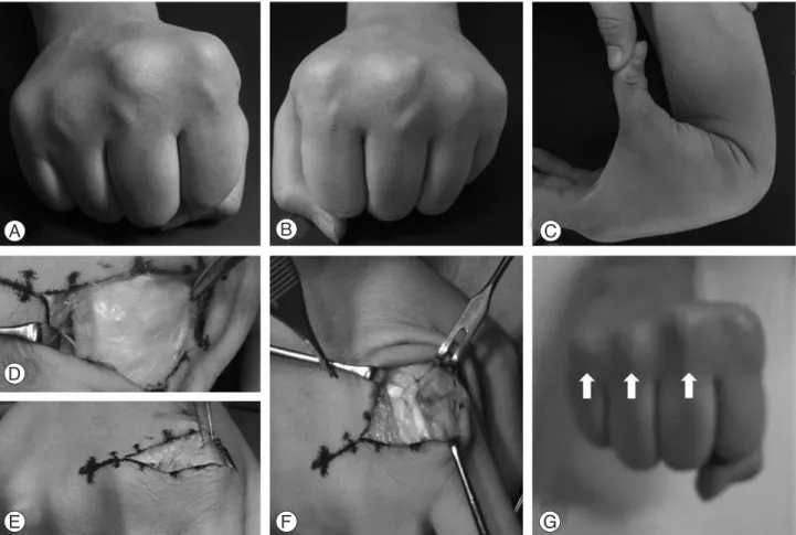 Fig. 1. Twenty five year-old man. (A, B) He showed bilateral multiple extensor tendon dislocations