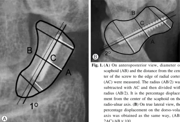 Fig. 1. (A) On anteroposterior view, diameter of scaphoid (AB) and the distance from the  cen-ter of the screw to the edge of radial cortex (AC) were measured
